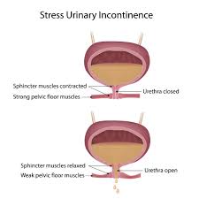 Image result for Urinary Incontinence