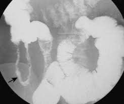Crohn's disease is a form of inflammatory bowel disease (ibd) that causes inflammation to the lining of the digestive or gastrointestinal (gi). The Small And Large Intestine Clinical Gate