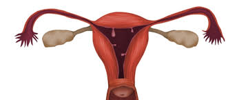 لحمية الرحم حالة قد تسبب العقم ويب طب