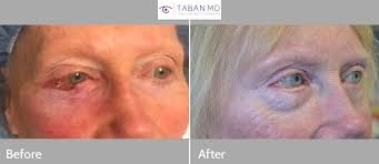 Can you spots the signs? Eyelid Skin Cancer Before And After Photos Taban Md