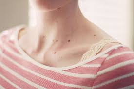 Rodinki Na Shee U Muzhchin I Zhenshin Znachenie Prichiny Vozniknoveniya Helperlife Ru Yandeks Dzen