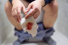 Image result for Blood in stool
