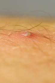 Fata, gat, axile, pe partea interioara a coapselor, pe abdomen, pe fese. Furunculul