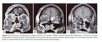 La mucormicosis cutánea primaria es una infección micótica rara que se asocia a estados de inmunosupresión. Scielo Saude Publica Coinfeccion De Mucormicosis Rinocerebral Y Aspergilosis Sinusal Coinfeccion De Mucormicosis Rinocerebral Y Aspergilosis Sinusal