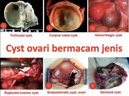 Siapa yang tidak kenal nasi goreng? Makan Supplemen Tak Boleh Rawat Ovarian Cyts Doktor Nasihat Wanita Supaya Tak Tertipu
