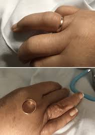 Image result for Ring Removal