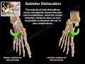Image result for Subtalar Dislocation