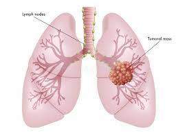 Signs and symptoms caused by cancer will vary depending on what part of the body is affected. Lung Cancer Stock Illustrations 10 389 Lung Cancer Stock Illustrations Vectors Clipart Dreamstime