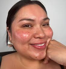 I'm Insecure again 😩 my rosacea, psoriasis and eczema flared up again all  at the same time! Am I freaking out? Yes. And because of it I can't film  again…. And I'm