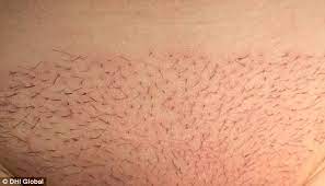 Can monistat make your hair grow? Surge In Women S Hair Transplants On Their Bikini Lines Daily Mail Online