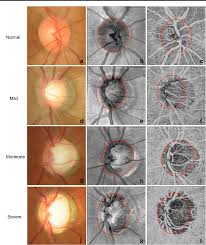 The optic nerve is the bundle of nerve fibers at the back of the eye that carry visual messages from the retina to the brain. Correlation Between Optic Disc Perfusion And Glaucomatous Severity In Patients With Open Angle Glaucoma An Optical Coherence Tomography Angiography Study Semantic Scholar