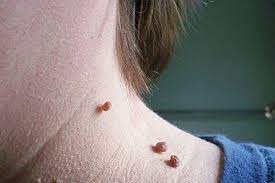 Then the doctor stitches or. Skin Tag Removal Alison Taylor Medical Cosmetics Cheltenham