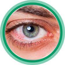 Blanc de l'œil rouge ou jaune, iris qui change de couleur, reflet blanc dans la pupille… la couleur de vos yeux peut en dire long sur votre santé. Yeux Rouges Causes Bepanthen Collyre