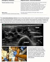 Image result for Axillary Nerve Block
