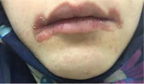 Image result for Angular Stomatitis