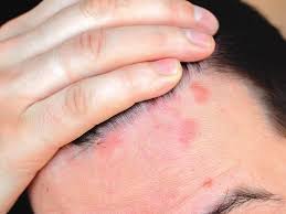 Image result for sores on the head in children