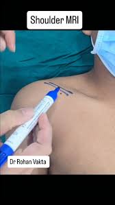 Image result for Subacromial Space Injection