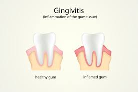 Image result for Gingivitis