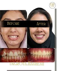 Non extradition orthodontic treatment. زیباتر لبخند بزنید🥰 رفع بهم ریختگی  دندانها بدون کشیدن دندانها. #dentistlife #dentistrylife #smiles #دندانها  #دندان_پزشک #متخصص_ارتودنسي_اصفهان #ارتودنسي #دكتر_رويا_هاشمي #اكسبلور