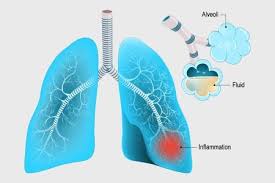 Check spelling or type a new query. Respiratory Tract Infection Rti Urti Lrti Pneumonia Tuberculosis Tb Symptoms Diagnosis Treatment