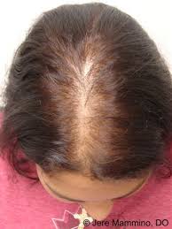 First things first, it depends on the pill you're an increase in androgens will lead to thinning of hair, which could then result in female pattern hair loss similar to the androgenetic alopecia in men. Female Pattern Hair Loss American Osteopathic College Of Dermatology Aocd