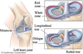Initial treatment of meniscal tears should be aimed at controlling . Meniscus Tear Care Instructions