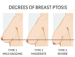 Saggy Breasts (Breast Ptosis): Causes & Treatments | Harley Medical