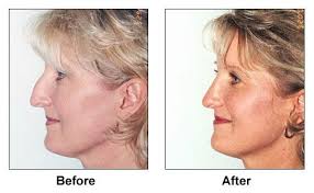 Rhinoplasty Seattle Bellevue Nose Job Nose Plastic Surgery Plastic Surgery Nose Plastic Surgery Rhinoplasty