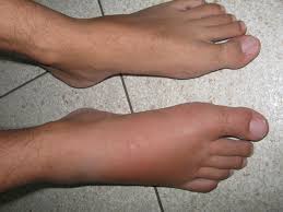 Image result for erysipel photos)