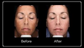 Image result for Melasma