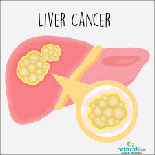 Common signs and symptoms of cancer in both men and women include: Liver Cancer Causes Symptoms And Treatment