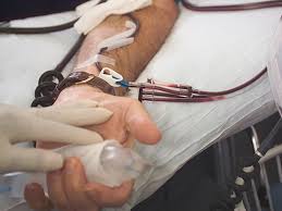 Image result for Apheresis