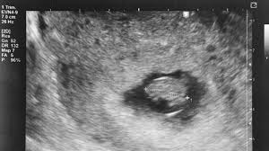 Women expecting a pregnancy and who misses her period, normally goes for upt ie urine pregnancy test to detect her pregnancy. 7 Week Ultrasound What You Should See And Why You May Not