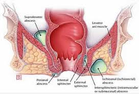 Image result for Perianal Abscess