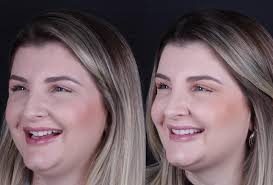 Transformação do sorriso by Dr. Felipe Valverde #lentesdecontatodental