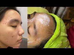 BÀI 10: Quy trình VI kim tảo biển nano PEEL DA tại spa điều trị mụn ẩn thâm  mụn sẹo thâm mụn