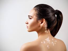 Ecco tutte le risposte in parole semplici. Macchie Bianche Sulla Pelle Cosa Sono Le Macchie Bianche Tanta Salute