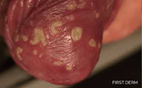 Image result for penis mycosis symptoms