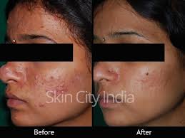 Skin City India Chemical Peeling Results Explore Skin City India Clinic S Chemical Peels Before And Chemical Skin Peel Chemical Peel Skin Care Routine Steps
