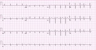 Atrial Fibrillation Ecg Classification Causes Risk