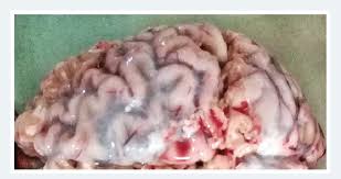 Image result for Tertiary Syphilis