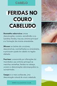 ↑ a b c d sabbag, cy, psoríase descobertas além da pele (2010). Feridas No Couro Cabeludo Como Evitar Cuidados Com O Cabelo Loiro Dicas De Cabelo Citacoes De Salao De Beleza