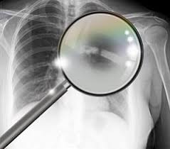 Average Settlement Value Of Broken Ribs