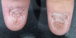 Image result for Onychotillomania feet
