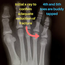 Image result for Toe Fracture