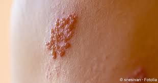 Gürtelrose (herpes zoster) tritt meistens in höherem lebensalter auf. Gurtelrose Herpes Zoster Ansteckung Symptome Behandlung Netdoktor
