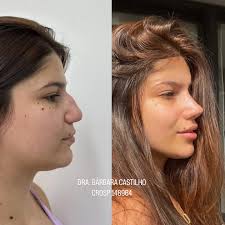 E esse ANTES e esse DEPOIS?? 😍👃🏼 2 meses separam uma foto da outra e só  vai melhorando 🫶🏼💓 (fotos enviadas pela paciente) . . . Dra Bárbara  Castilho CROSP 148964 . . .