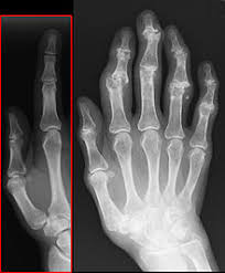Nutzt sich der knorpel ab, hat dies ebenso folgen für. Arthrose Wikipedia