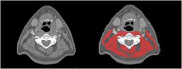 Sarcopenia Measured With Handgrip Strength And Skeletal Muscle Mass To Assess Frailty In Older Patients With Head And Neck Cancer Journal Of Geriatric Oncology