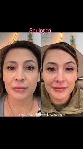 That 6 week Sculptra follow up has me like 🤩😍🤩, The soft contour, the  firming of the face, the reduction of fine lines and dark spots…and that  GLOW!!!🥰, Did I mention Sculptra is plant based and last ...